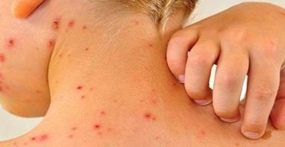 Менингококкт халдварын нэг тохиолдол батлагджээ